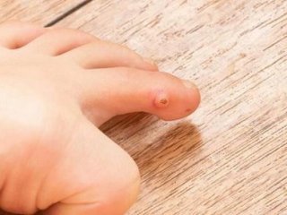 میخچه چگونه درمان می‌شود؟