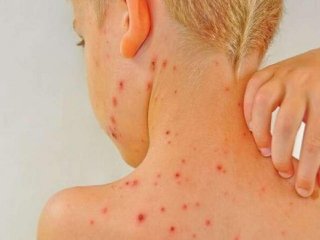 آبله مرغان برای چه افرادی خطرناک است؟