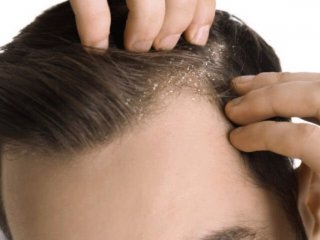 شوره سر دارید؟ شاید دلیلش کمبود این ویتامین باشد