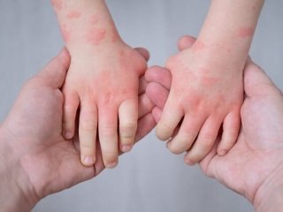 آیا اگزما در کودکان درمان دارد؟