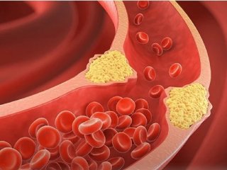 برای کاهش سریع چربی خون چه بخوریم؟