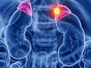 هیپرآلدوسترونیسم: علائم، علل، تشخیص و درمان
