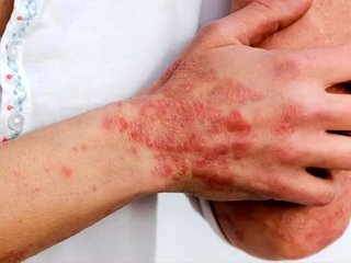 یکی از عوامل ابتلا به بیماری‌های خودایمنی در زنان