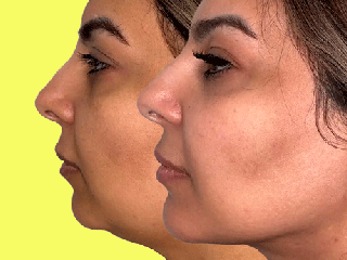 سایه روشن های رفع غبغب با مزوتراپی