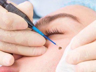 برداشتن خال با لیزر