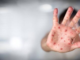 ورود «آبله میمونی» به ایران صحت دارد؟