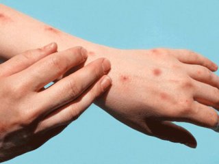 آشنایی با آبله میمون، علائم، پیشگیری و درمان