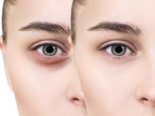 پف دور چشم نشانه چه بیماری است؟