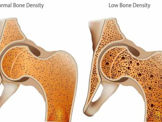 ۱۰ راهکار برای افزایش تراکم استخوان‌ها