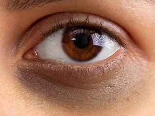 سیاهی دور چشم نشانه چه بیماری است؟