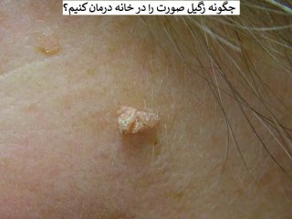 5 روش فوری و موثر برای درمان زگیل صورت در خانه