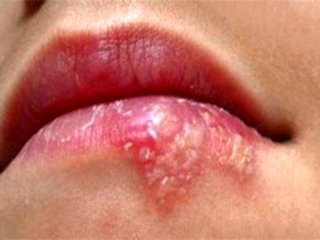 تبخال لب تا چه زمانی واگیر دارد؟