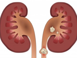 مبتلایان به «سنگ کلیه» بخوانند