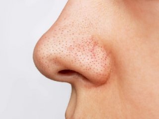 با منافذ باز پوست چه کنیم؟