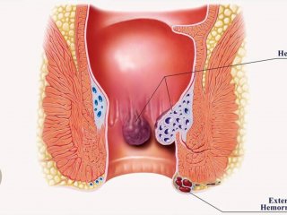 هموروئید چیست؟
