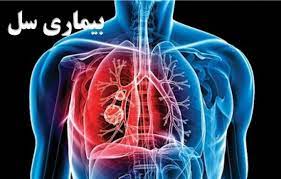 تشخیص و درمان رایگان سل در کشور