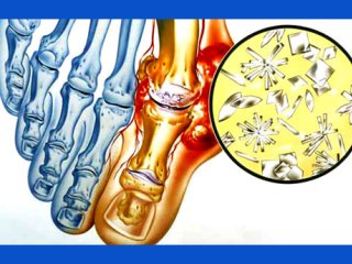 مواد غذایی بهبود دهنده و تشدید کننده بیماری نقرس را بشناسید