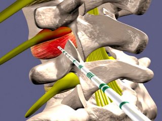 کاربرد و تأثیرگذاری اوزون تراپی دیسک گردن