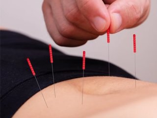 کاهش خطر سکته مغزی در مبتلایان به آرتریت روماتوئید با طب سوزنی