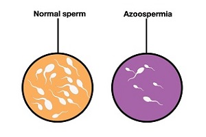 علل و درمان آزواسپرمی یا ناباروری مردان بدون اسپرم