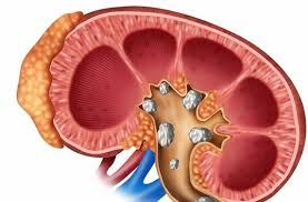 سنگ کلیه در تابستان و آنچه باید در مورد آن بدانید