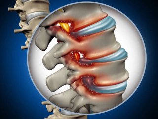 درمان دیسک کمر + معرفی بهترین روغن برای دیسک کمر