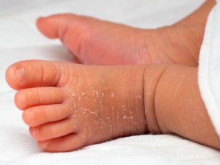 دلایل و درمان خشکی پوست نوزادان