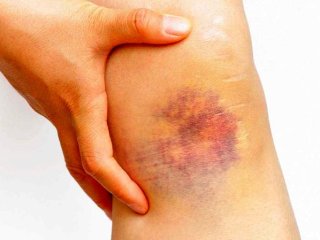 چرا به راحتی کبود می‌شویم؟