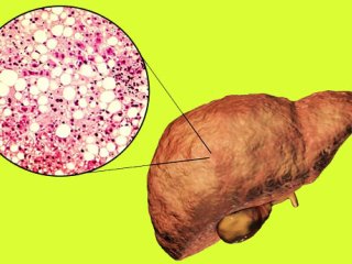 کبد چرب ؛ از علت تا راه های درمان