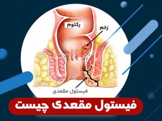 علائم فیستول مقعدی و روش های درمان