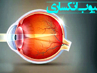 راه های شناسایی و درمان عیوب انکساری چشم