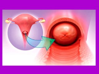 راهکارهای پیشگیری از سرطان گردن رحم