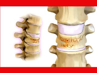 پوکی استخوان و نقش تغذیه در پیشگیری از آن