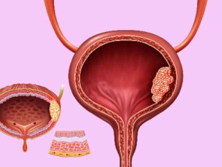 تومور مثانه و راهکار های تشخیص و درمان