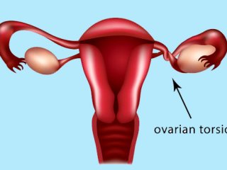 پیچ‌خوردگی تخمدان؛ علل و عواقب