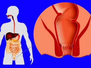 شقاق مقعدی چیست؟