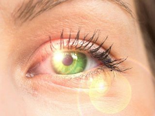 آفتاب‌سوختگی چشمی چیست؟