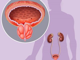 برای جلوگیری از ابتلا به سرطان پروستات این کار مهم را انجام دهید