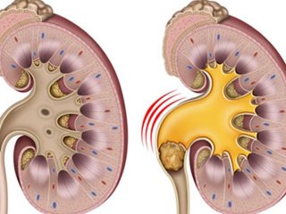این ماده را هر روز بخورید تا سنگ کلیه نگیرید