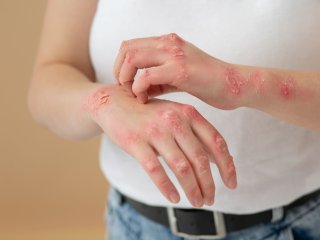 علائم حیاتی اگزما: چگونه بفهمیم که اگزما داریم؟
