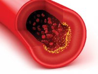 توصیه‌های لازم تغذیه‌ای برای پرفشاری خون با دلایل علمی