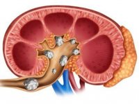دفع سنگ کلیه با نوشیدنی های خانگی