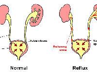 خطرات ریفلاکــس ادراري