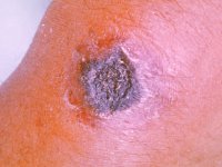 از سیاه زخم چه می دانید؟