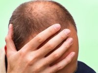 درمان های خانگی طاسی