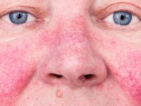 رهایی از رگ های عنکبوتی پوست صورت