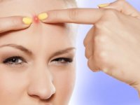 درمان جوش های روی پیشانی