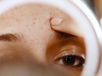 پاکسازی پوست در نوجوانی