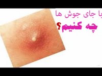 با جای جوش‌ ها چه كنيم؟