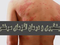 پيشگيری و درمان اگزمای سرشتی